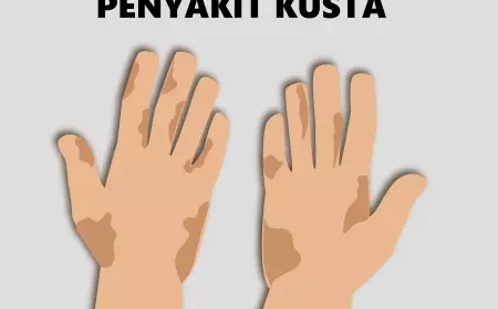 Dalam 3 Tahun, Kota Batu Catat 10 Kasus Penderita Kusta