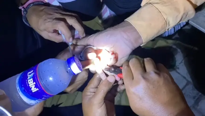 Dokter Angkat Tangan, Petugas Damkar Sampang Evakuasi Cincin dari Jari Balita