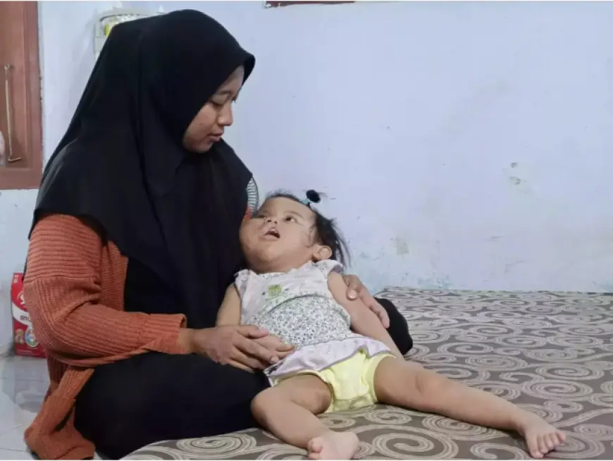 Miris! Balita Probolinggo Sulit Berobat karena Sindrom Proteus Langka