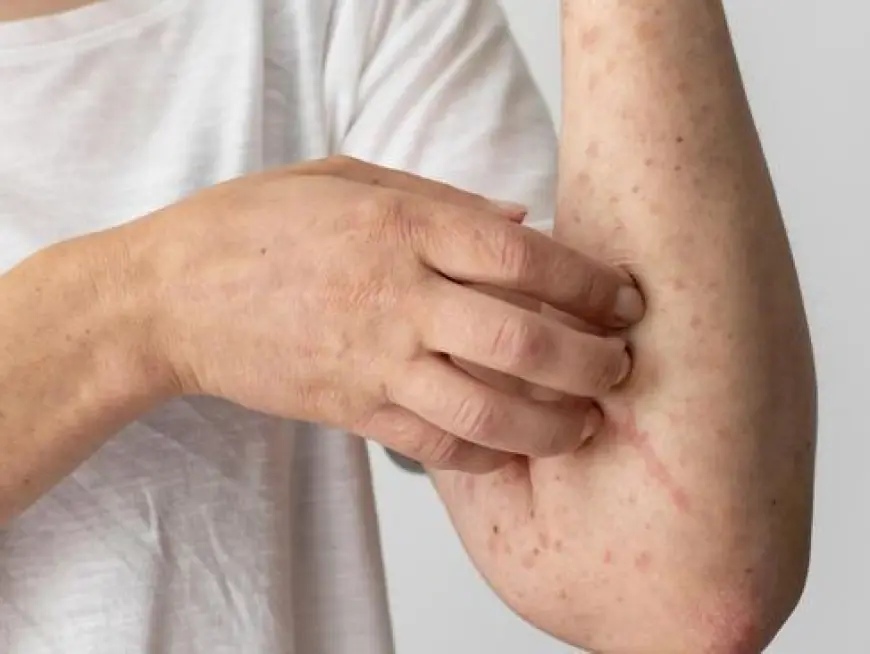 Dosen FIKKIA Unair Sebut RI Belum Sepenuhnya Aman dari Campak Meski Kasus Turun 90 Persen